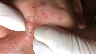 ОГРОМНЫЕ СОЧНЫЕ ЧЕРНЫЕ ТОЧКИ НА ЛИЦЕ, УДАЛЕНИЕ