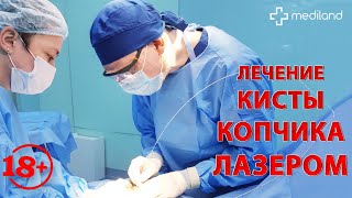 Как проходит операция по удалению кисты копчика лазером в МЦ Mediland?