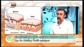 Liposuction - Yağ Aldırma Uygulamaları - Tüm Detaylar - Hayatı Güzel Yaşa - TRT Avaz