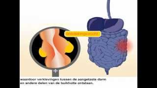 Ziekte van Crohn - Symptomen en behandeling van de ziekte van Crohn
