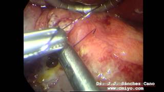 Ulcera duodenal perforada. Sutura simple por laparoscopia.