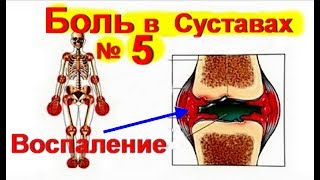 Боль в Суставах ! Лечение суставов № 5. Артрит. Артроз. Как лечить суставы / ed black