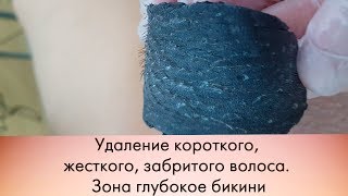Удаление волос в зоне бикини