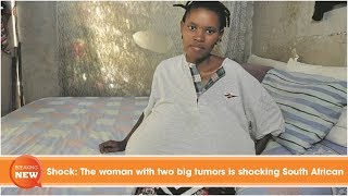 Shock: The woman with two big tumors is shocking South African