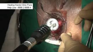 Rectal Prolapse in Female | STARR Surgery Video | Dr. Ashwin Porwal