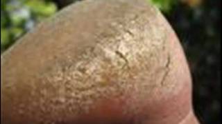best cracked heel repair