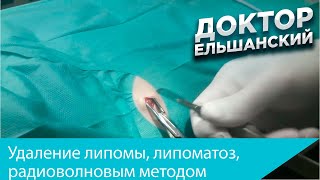 Удаление липомы при липоматозе из небольшого разреза радиоволновым методом