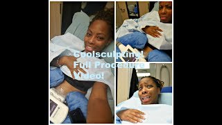 Coolsculpting: Freeze away fat! Full Procedure video!