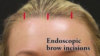 Brow lift & Forehead lift