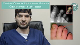 Молоткообразная Деформация пальцев обо всем @Ортопедия ProСтопы