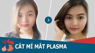 Cận cảnh kết quả cắt mí Plasma sau 30 ngày tại Kangnam