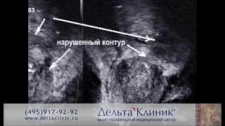 ТРУЗИ предстательной железы. Трансректальное УЗИ простаты в Дельта Клиник