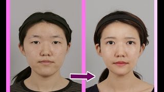 Trước và sau phẫu thuật hàm Vline Hàn Quốc