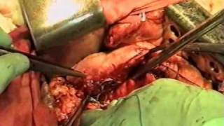 Резекция желудка-resection of the stomach