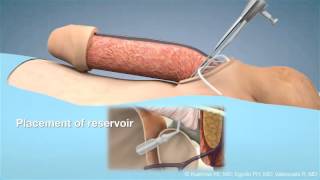 Penile Prosthesis Surgery SCIPP 1