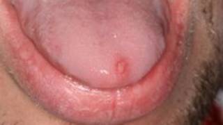 DermTV - The Difference Between Canker Sores and Herpes [DermTV.com Epi #103]