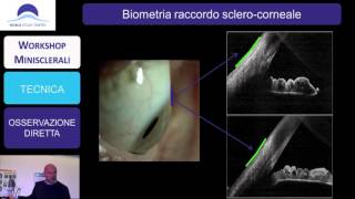 Workshop Minisclerali 8 Maggio 2015 - Complicanze - Tecniche e strumenti