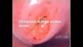 Кольпоскопия
