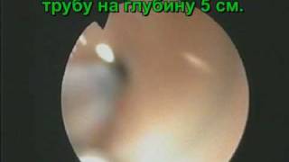Маточная труба. Катетеризация через гистероскоп.