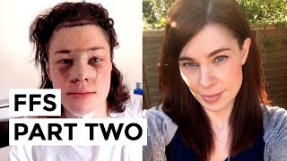 Facial Feminisation Surgery (FFS) - Part 2: Recovery & Results