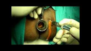 KSHAR SUTRA TREATMENT- BY DR.SACHIN GUPTA M.S (AYU)-09419960202