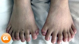 15 People With Extra Body Parts
