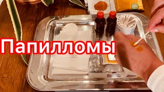 Простой способ удаления папиллом