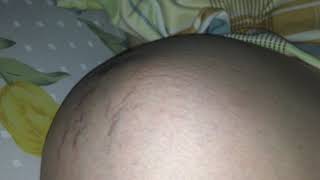Breech baby kicking & moving inside mom’s belly - 9 days before natural delivery. thai ngôi ngược