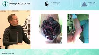 Реконструктивно-пластические операции в лечении местно-распространенных форм сарком мягких тканей