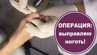 Моя операция: Вросший ноготь. Исправление. Титановая нить. Советует врач-подолог
