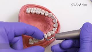 SONICflex stripping & shaping– caso clinico 01