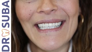 Prothèse fixe sur implant Découvrez la réalisation Couronne et bridge implant