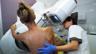 ¿Cuáles son los principales síntomas del cáncer de seno y cómo realizar su detección temprana?