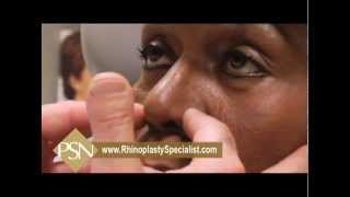 African American Rhinoplasty-Amazing Before & After Results