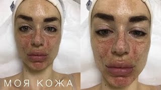 Я ЭТО СКРЫВАЛА - ЧТО С МОЕЙ КОЖЕЙ | удаляю пигментные пятна на лице