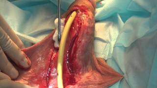 Stages_urethroplasty_Kotov