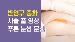 눈썹문신 반영구눈썹 푸른눈썹중화 진한문신 연하게하기 과정 풀영상!
