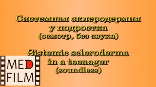 Системная склеродермия у подростка (осмотр) © Systemic Skleroderma in a teenager (soundless)
