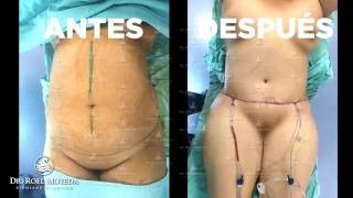 Tummy Tuck , Abdominoplastia o Lipectomia Dr Roel Moyeda