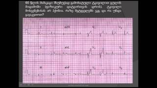 ეკგ / მიოკარდიუმის ქვედა კედლის ძველი ინფარქტი (გულის ინფარქტი) / ასპირინი
