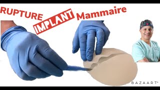 Chirurgie des seins : Rupture d'une prothèse mammaire