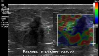 Эластография молочной железы + УЗИ молочных желез, опухоль.