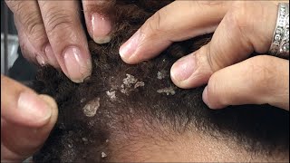 Dandruff Flake Scratching: “Cap Flakes!” Pt. 1 of 2