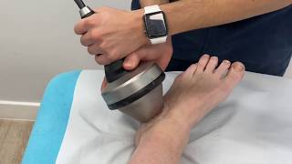 Piezowave focused shockwave on an acute ankle