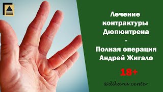 Полная операция - лечение контрактуры Дюпюитрена - 18+
