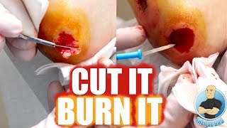 CUTTING OUT & BURNING A SUPER LARGE HEEL WART!!!