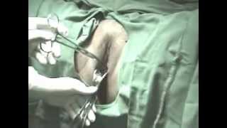 Dr T Biju Singh Mirena Insertion Technique