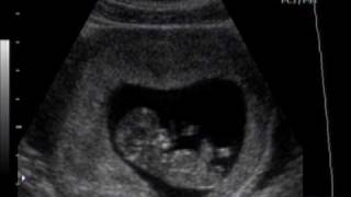 EMBARAZO DE 10  SEMANAS .DR. ARIEL RODRIGUEZ, UNION MEDICA, SANTIAGO, R.D.