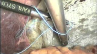 Laparoscopic Surgery for Left Diaphragmatic Eventration