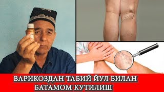 Варикоз касалликларидан табий  йул билан батамом кутилиш!